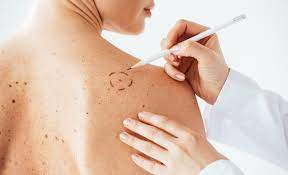 Doporučení odborníka na způsob melanom, jak se správně ubytovat