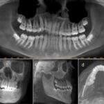 CBCT Dental Scan Radiation What Patients Need to Know