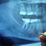 Dental CBCT Scan Cost in India An Insight 