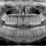 Protecting Yourself from Radiation from Dental CT Scans 